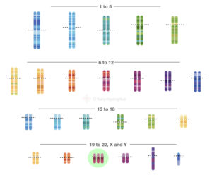 Karyotype Of Down Syndrome Trisomy 21 Explained KaryotypingHub