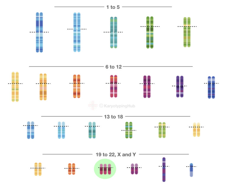 Karyotype Of Down Syndrome Trisomy Explained Karyotypinghub