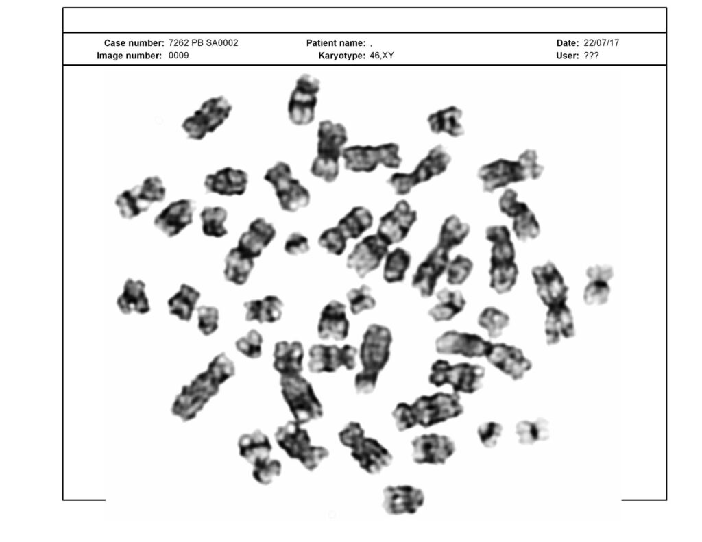 Not a good karyotyping results of G bands. Chromosomes aren't stained well. 