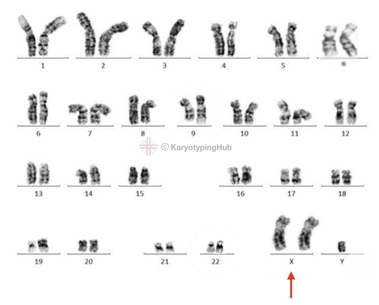 The actual karyotype image of Klinefelter syndrome. 