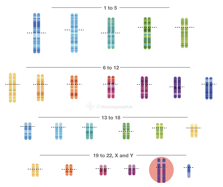 The graphical representation of Klinefelter syndrome.