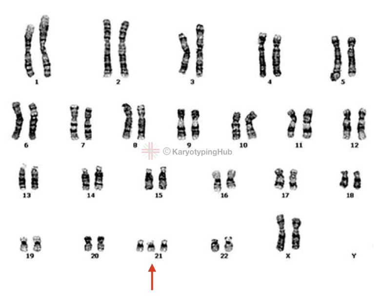 Karyotype of Down Syndrome (Trisomy 21)- Explained – KaryotypingHub