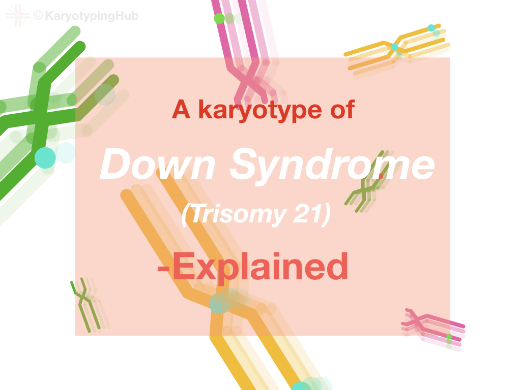 karyotype of Down syndrome