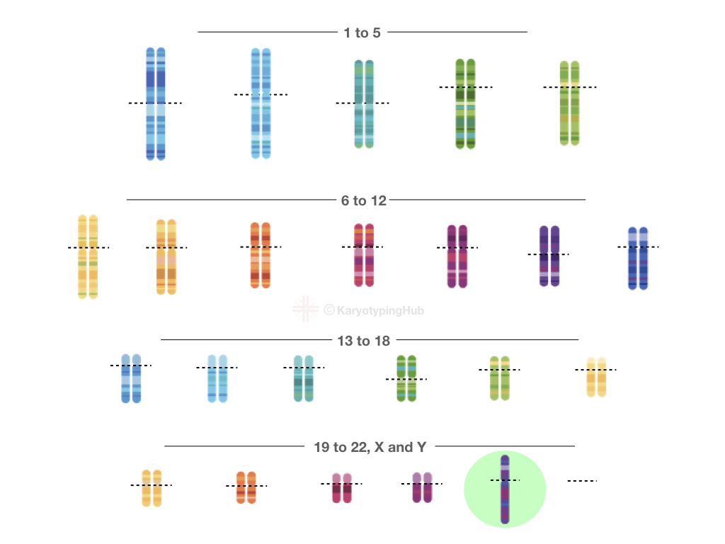 A karyogram of Turner Syndrome.