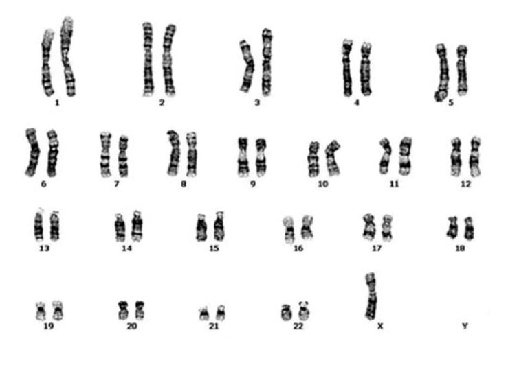 A karyotype of Turner Syndrome Explained KaryotypingHub