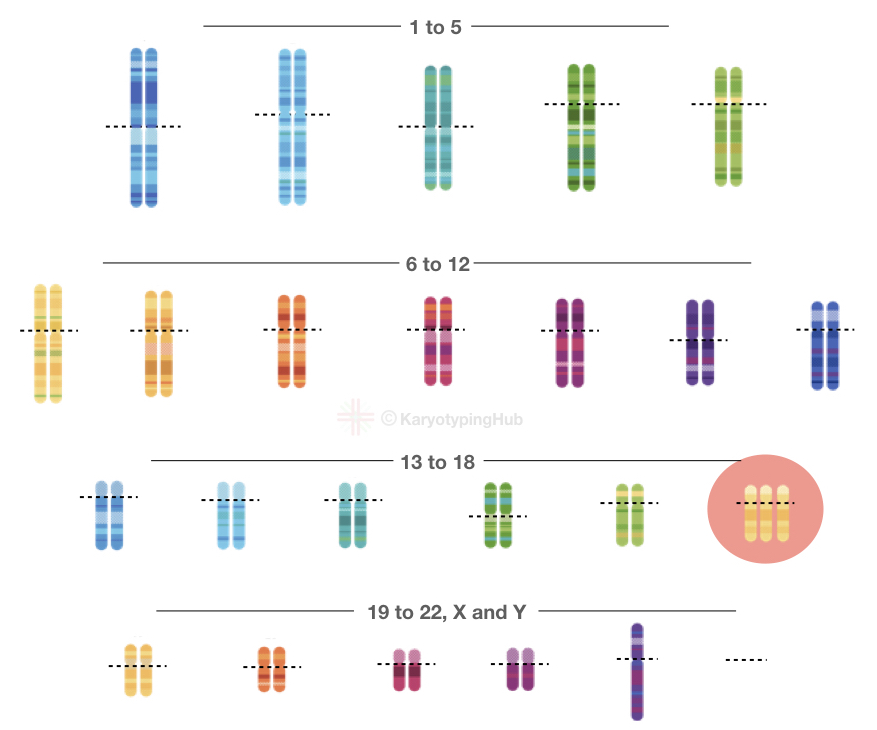 A karyotype of Edwards syndrome.