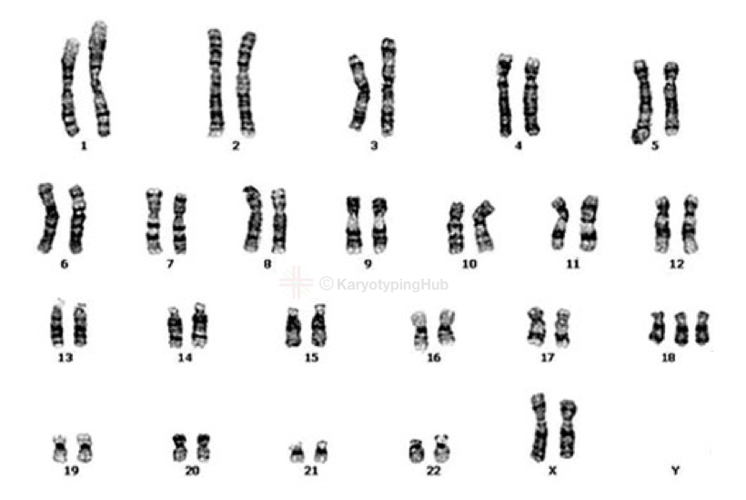 A karyotype of Edwards syndrome 