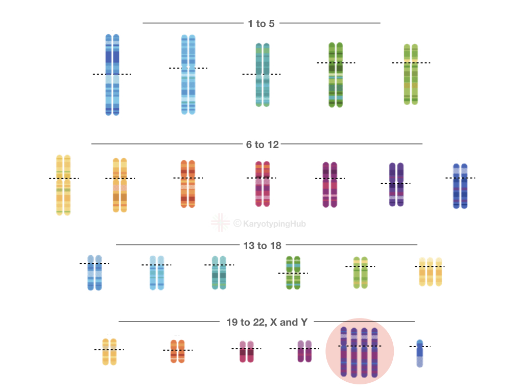 The XXXXY karyotype of a male. 