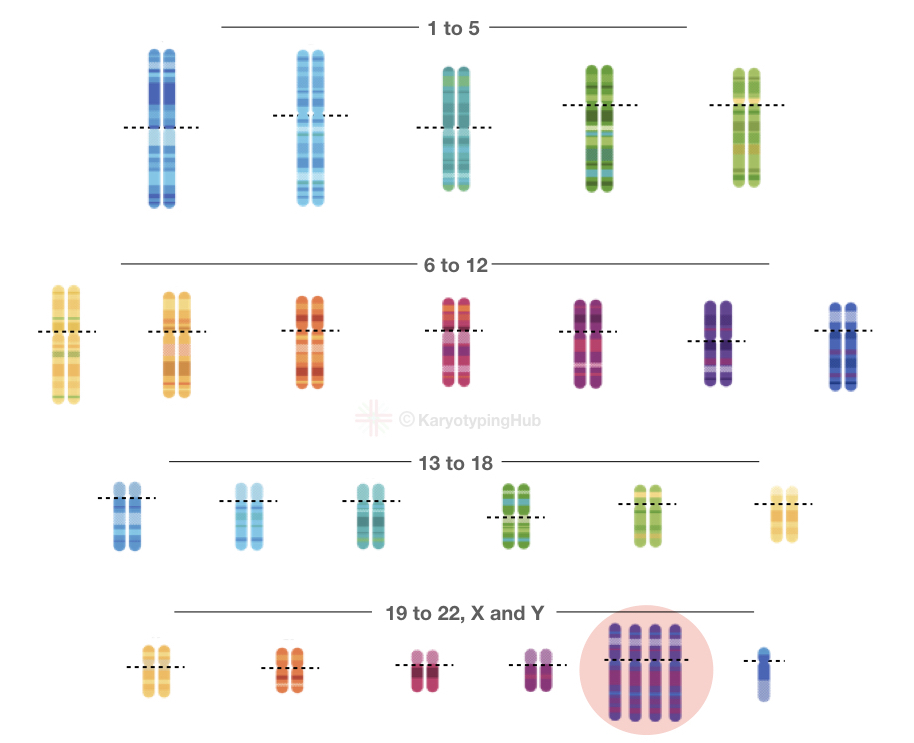 patau syndrome chromosomes