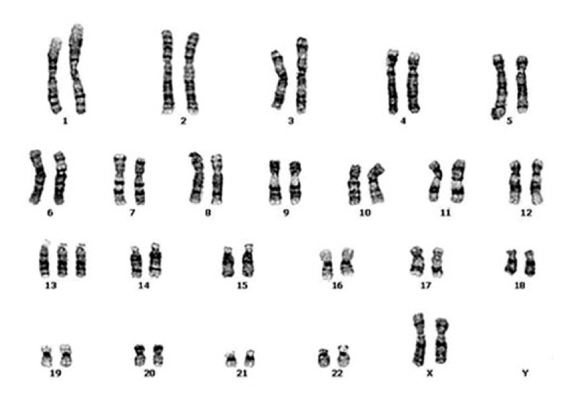 The Karyotype of the Patau syndrome. 