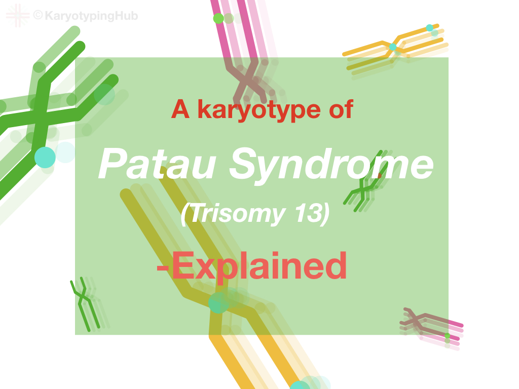 A karyotype of Patau syndrome explained.