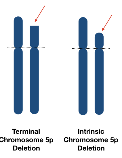 Pictorial representation of terminal and intrinsic chromosome 5p deletion.
